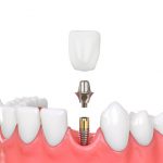jaw model tooth implant 3d illustration